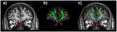 The Olfactory System Revealed: Non-Invasive Mapping by using Constrained Spherical Deconvolution Tractography in Healthy Humans